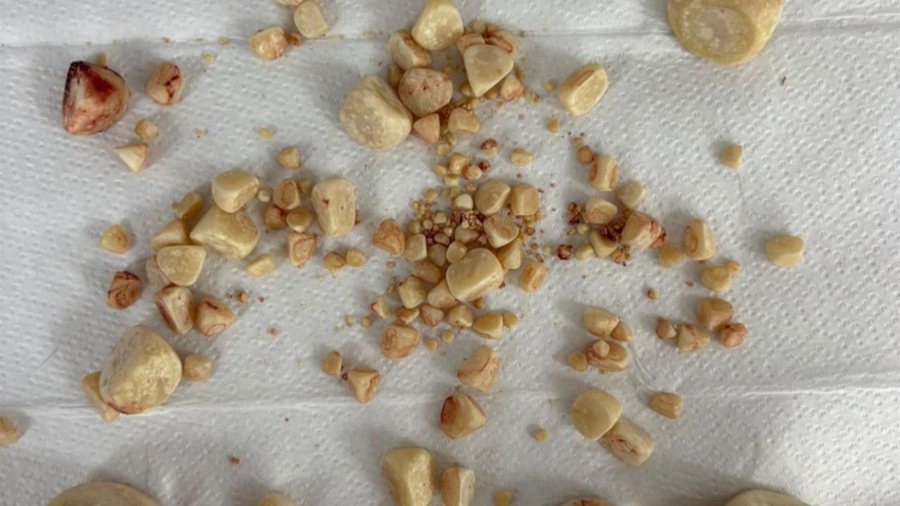 Gofret&#039;in idrar kesesinden 147 taş çıkarıldı